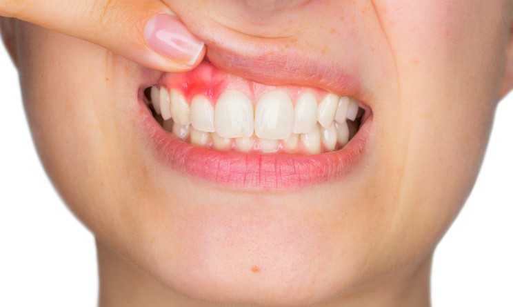 Gengivite: sintomi, cause e rimedi naturali