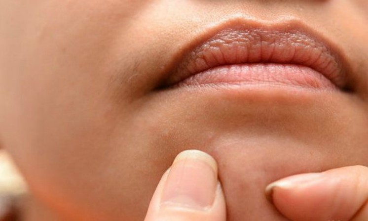 Punti bianchi rimedi naturali efficaci