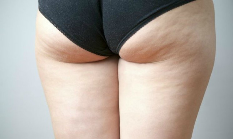 Cellulite, sconfiggerla con le onde d urto