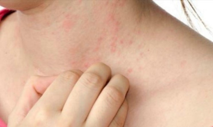 Rimedi naturali per la dermatite seborroica