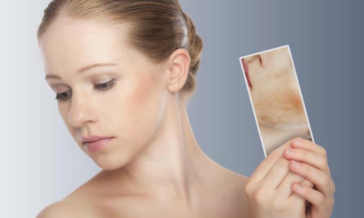 Rimedi naturali per la psoriasi