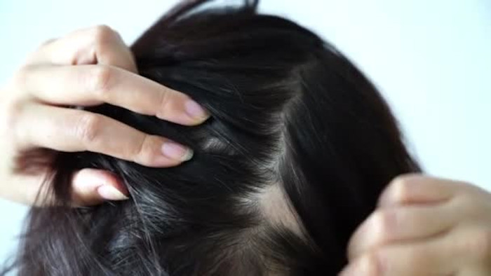 Alopecia da stress: i 7 rimedi naturali migliori