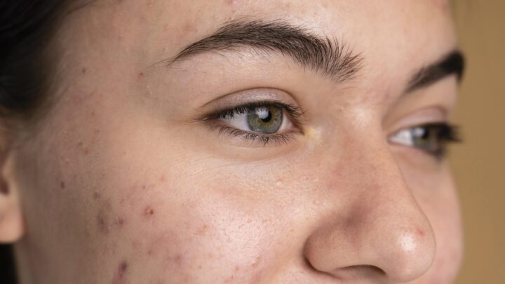 Punti neri: cosa sono? Ecco i rimedi più efficaci